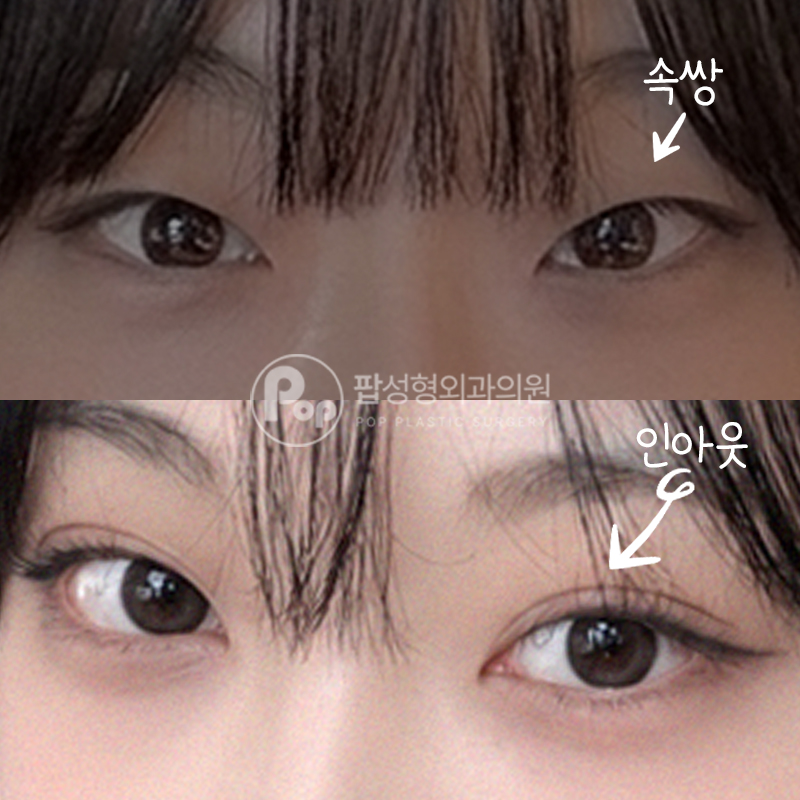 팝성형외과 날카로운 눈매 자연유착 매몰 쌍수 후기