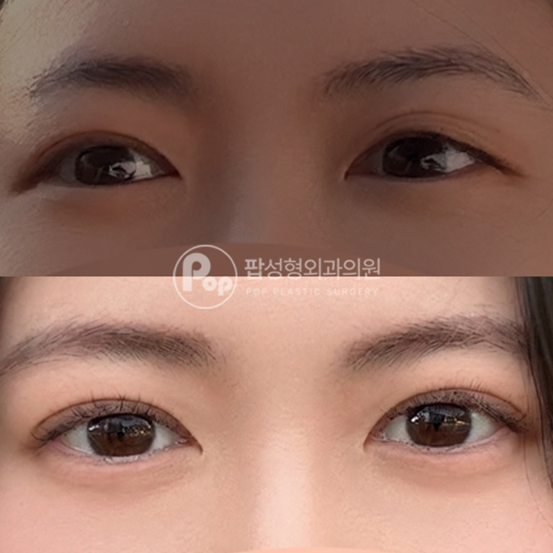 팝성형외과 풀린라인 자연유착 눈재수술 후기