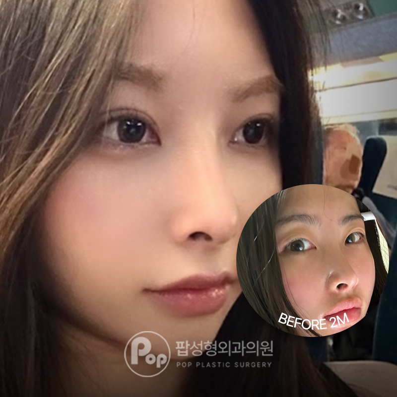 팝성형외과 겹쌍커풀 쌍수 눈매교정 2개월차 후기