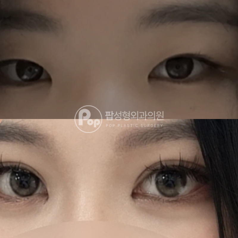 팝성형외과 작은눈 속쌍 자연유착 쌍수 후기