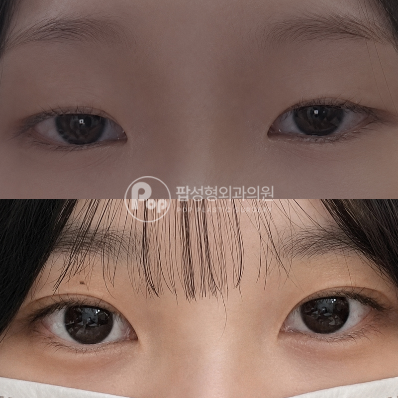 팝성형외과 인아웃라인 자연유착 후기