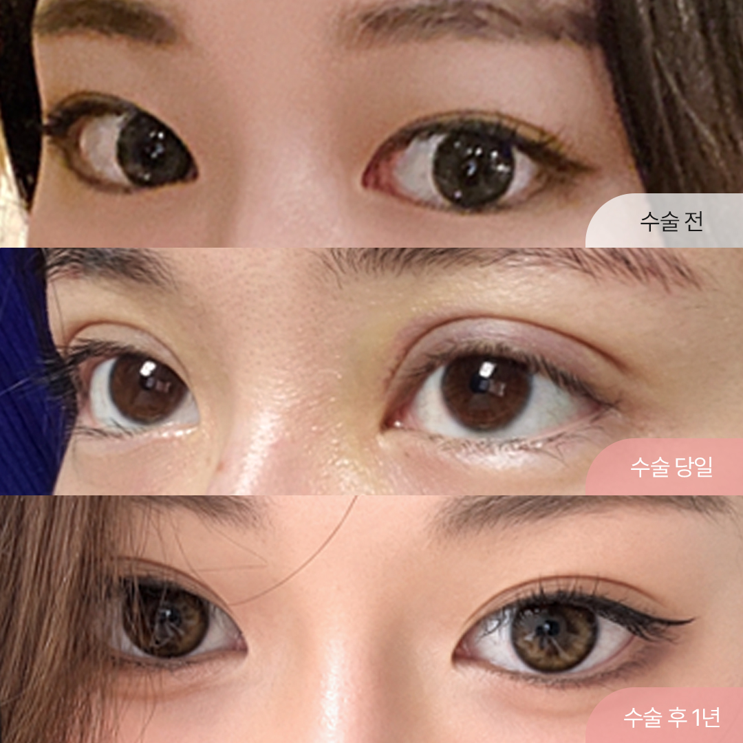 팝성형외과 세미아웃 자연유착 1년경과 찐후기