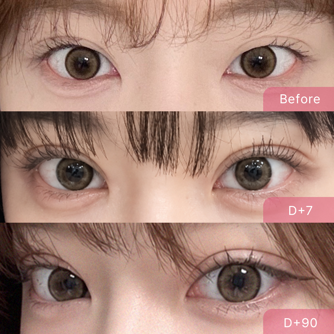 팝성형외과 비대칭 짝눈 자연유착 매몰 쌍수 후기