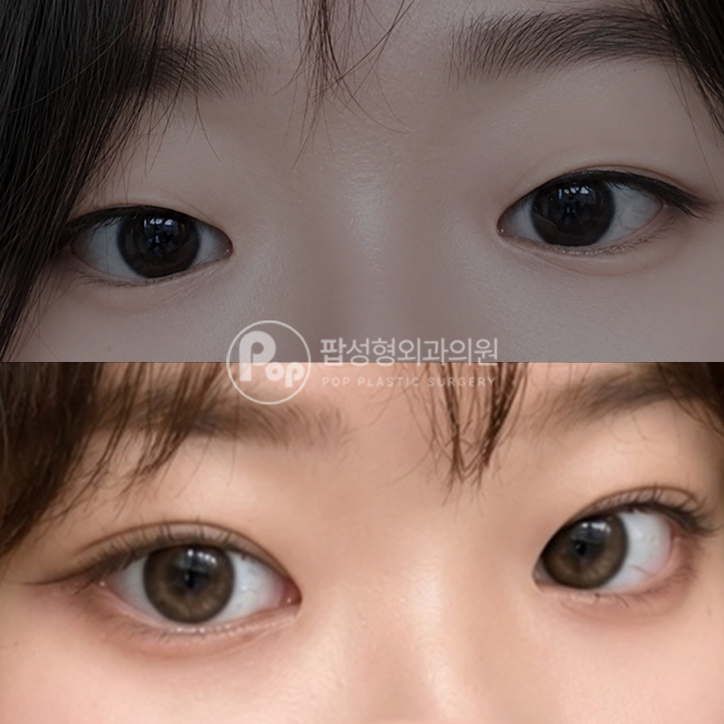 팝성형외과 답답한눈 눈성형 3개월차 후기