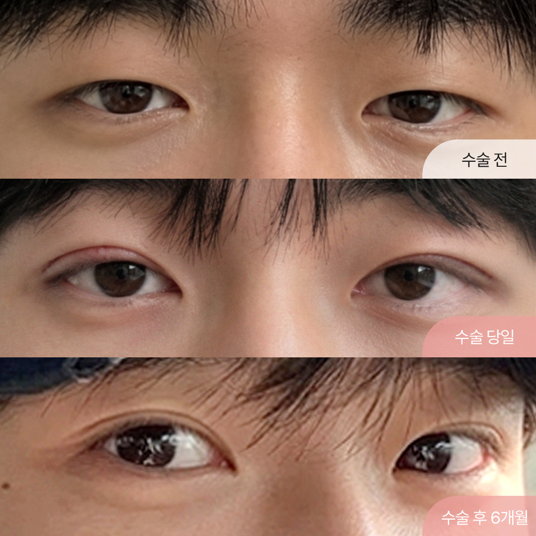 팝성형외과 남자눈성형 눈매교정 6개월차 경과 찐후기