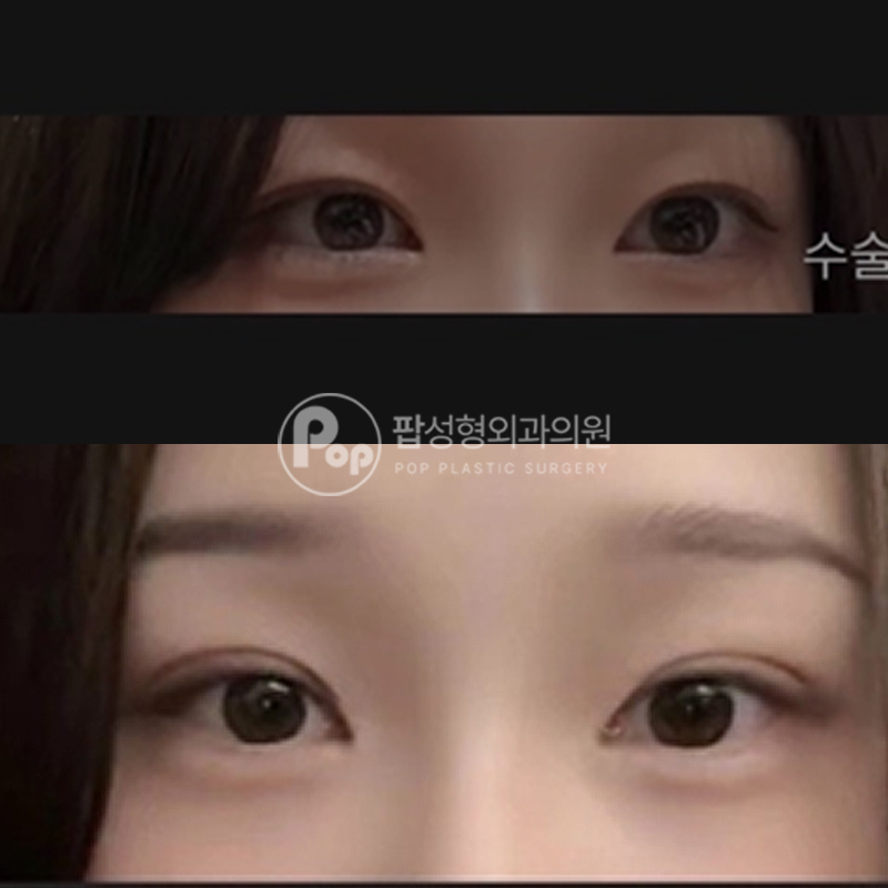 팝성형외과 절개쌍커풀 눈재수술 2개월차 후기