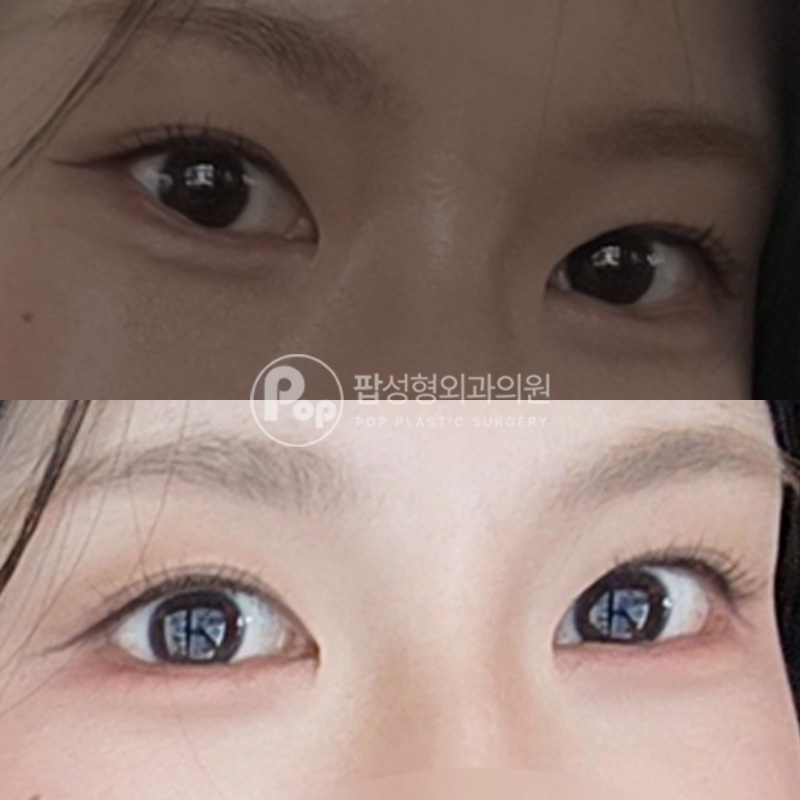 팝성형외과 꼬막눈 뒤트임 밑트임 3달차 후기