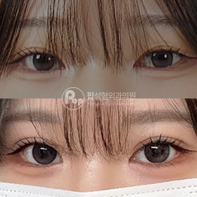 팝성형외과 절개에서 매몰 눈재수술 후기