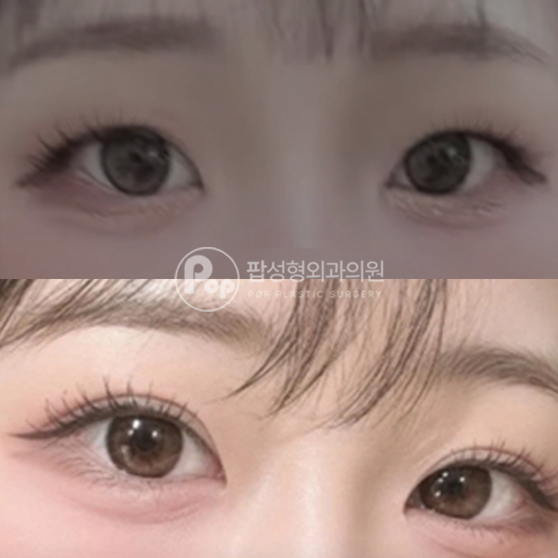 팝성형외과 풀린 속쌍 눈재수술 매몰 후기
