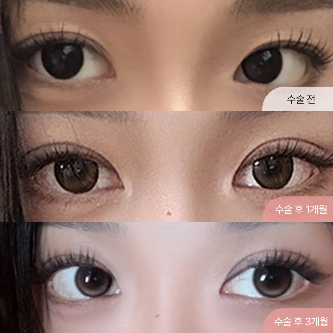팝성형외과 겹주름 겹쌍꺼풀 자연유착 후기