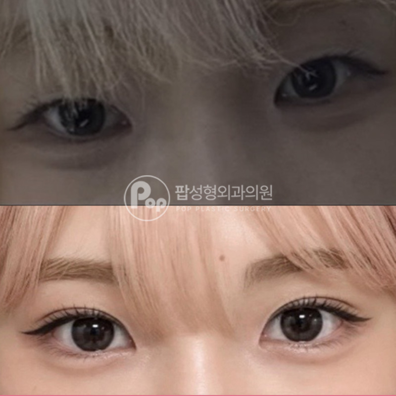 팝성형외과 무쌍 자연유착 앞윗트임 눈매교정 솔직후기