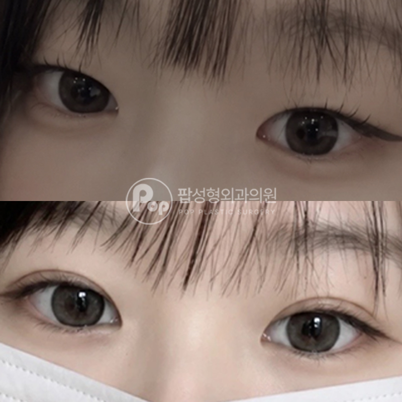 팝성형외과 무쌍 인아웃 자연유착 쌍수 눈성형 후기