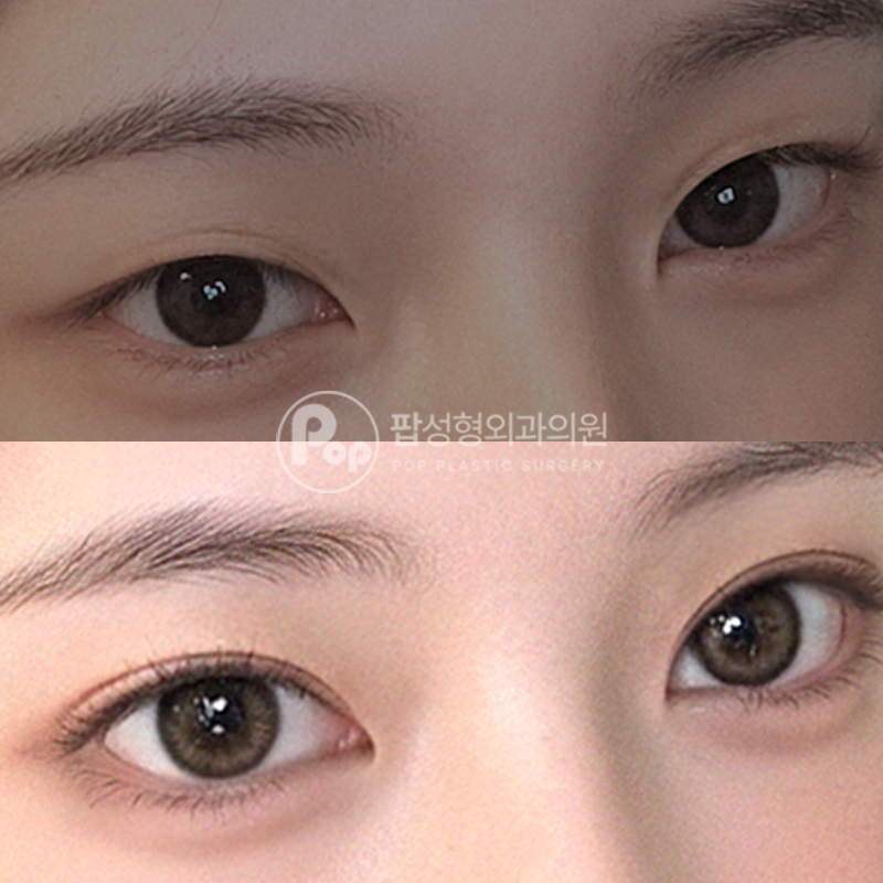 팝성형외과 무쌍 자연유착 후기