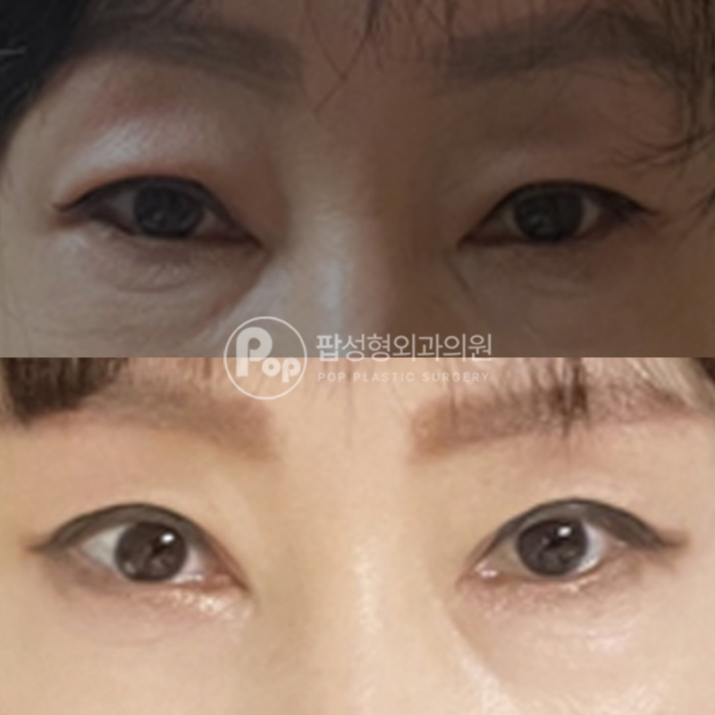 팝성형외과 중년눈성형 눈썹거상 자연유착 후기