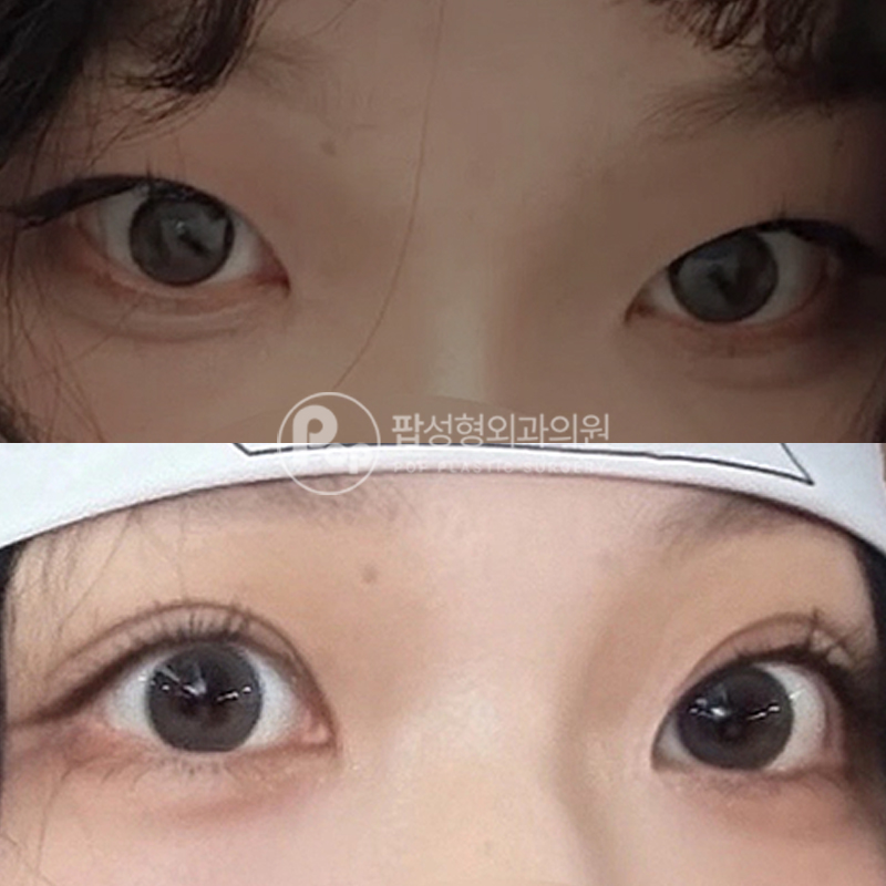 팝성형외과 안검하수 자연유착 후기
