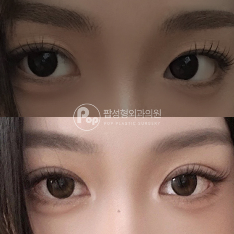 팝성형외과 겹쌍꺼풀 자연유착 후기