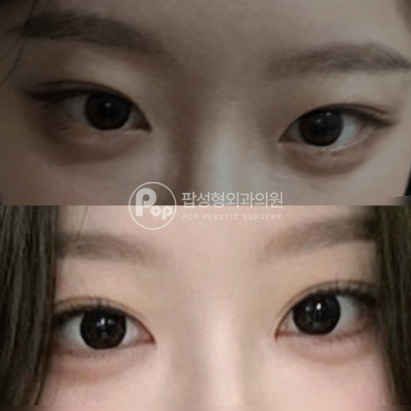 팝성형외과 자연유착 눈재수술 트임 후기
