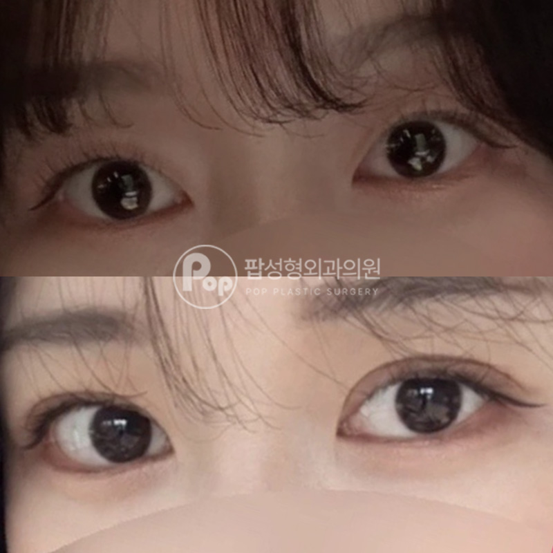 팝성형외과 인라인에서 인아웃라인 4개월차
