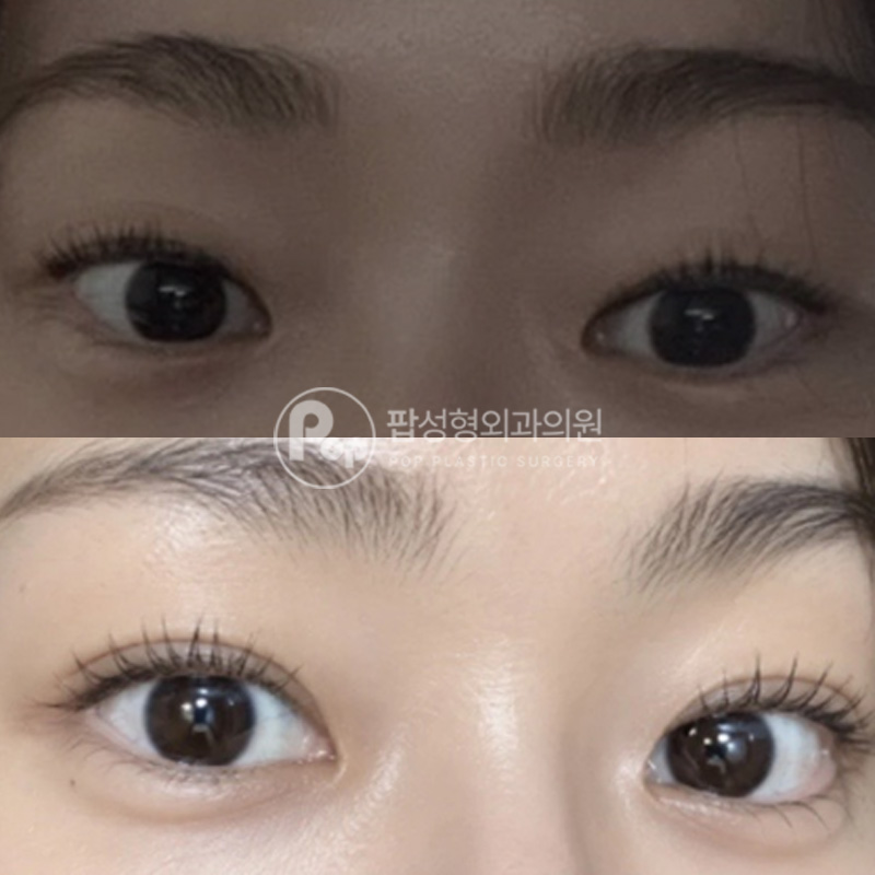 팝성형외과 처진눈 중년눈 4개월 후기