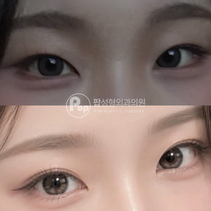 팝성형외과 자연유착 눈매교정 트임 후기