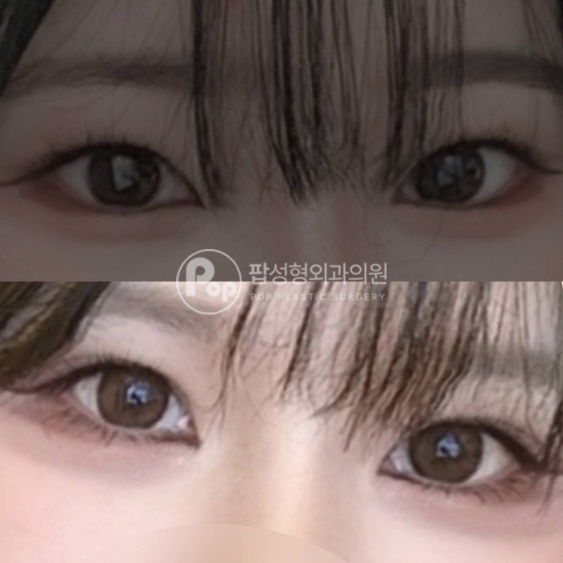 팝성형외과 풀린 쌍꺼풀 눈재수술 후기