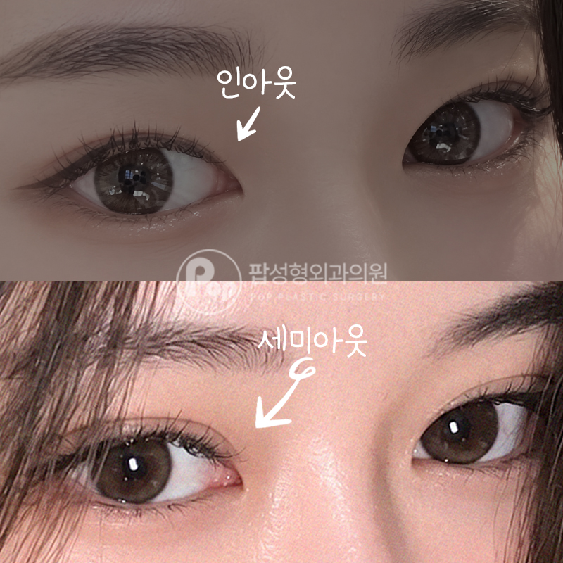 팝성형외과 인아웃→세미 라인변경 쌍수 2주차 후기