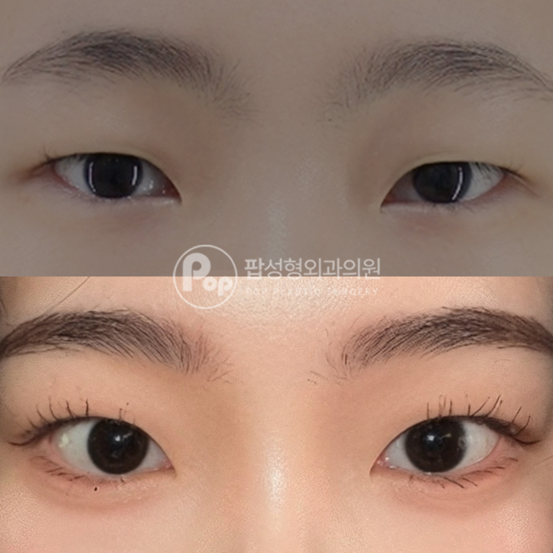 팝성형외과 무쌍 쌍커풀수술 후기
