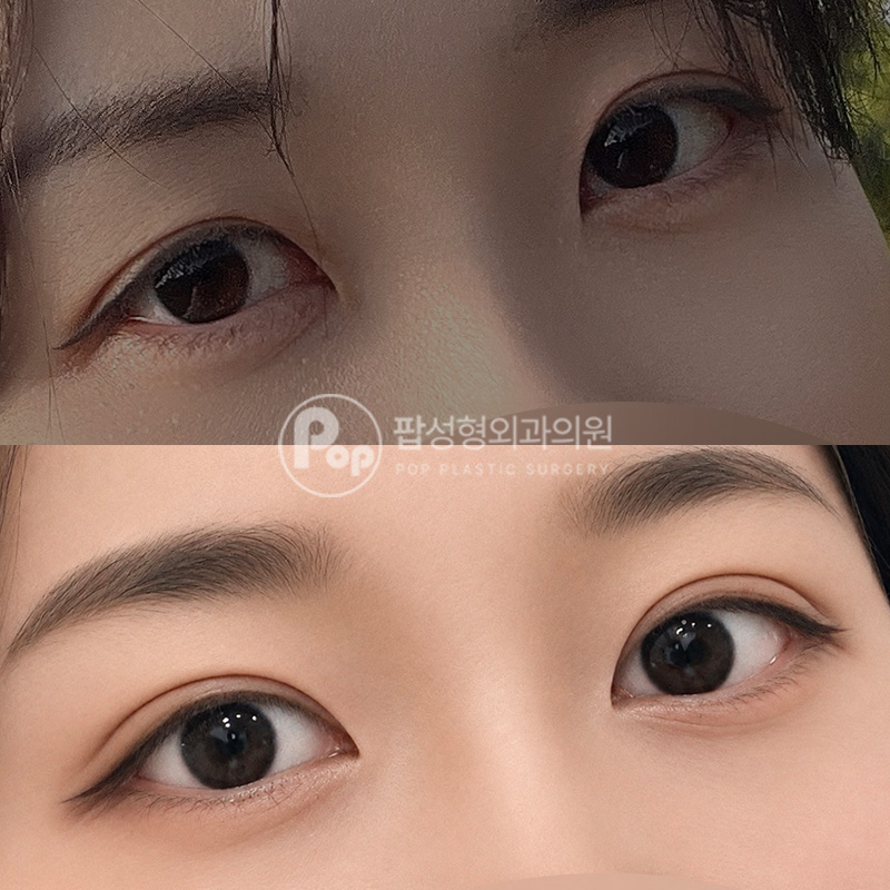 팝성형외과 처진눈 눈재수술 후기