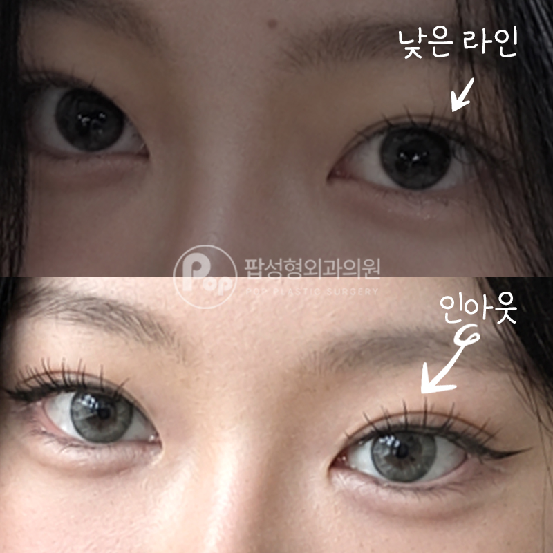팝성형외과 낮은 라인 라인 높이기 쌍수 후기