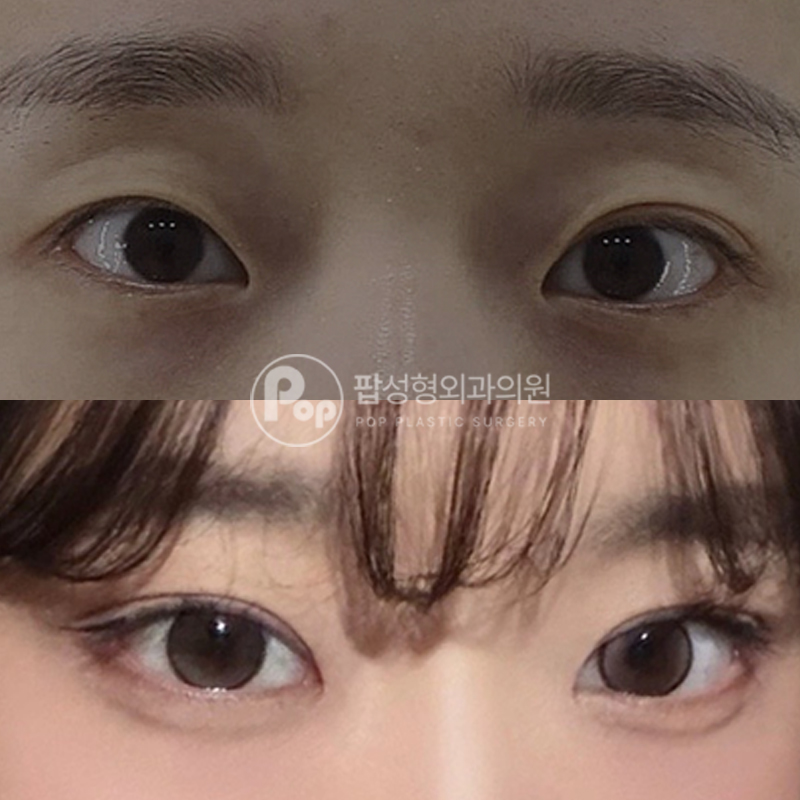 팝성형외과 풀린 짝눈 개선 후기