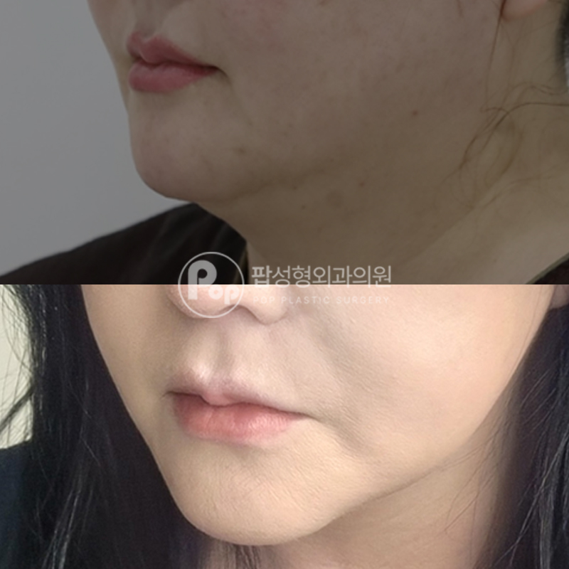 팝성형외과 이중턱 흡입 미니거상 후기
