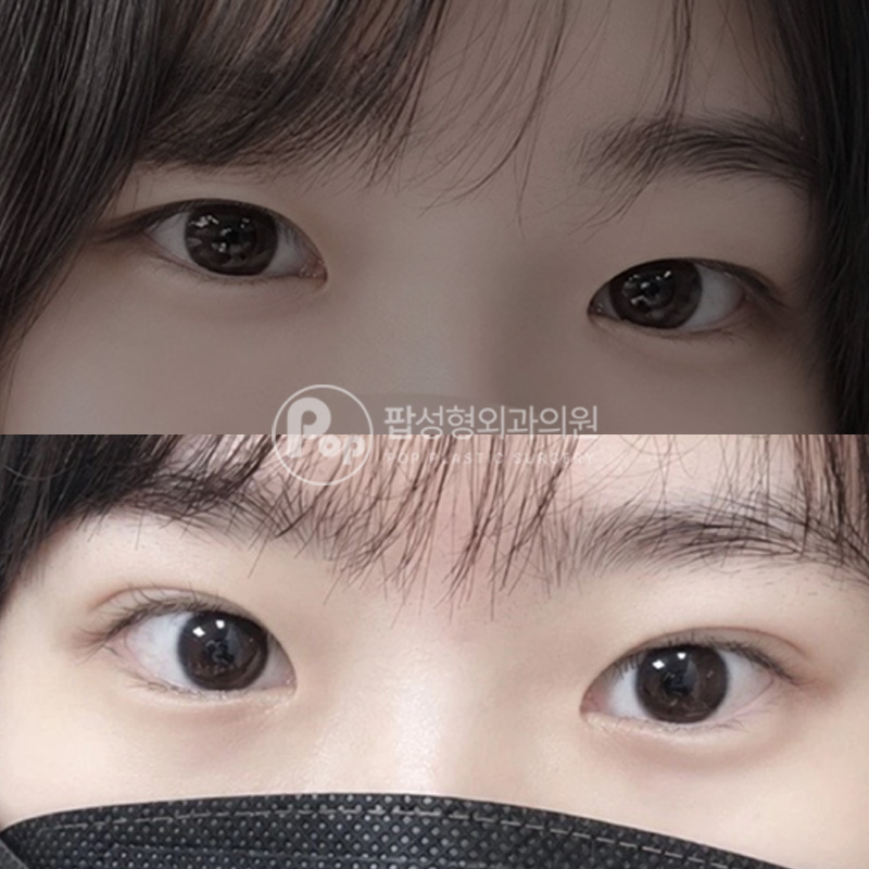 팝성형외과 자연유착 무쌍 눈매교정 2달차