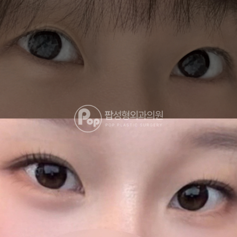 팝성형외과 짝눈 쌍수 눈매교정 후기