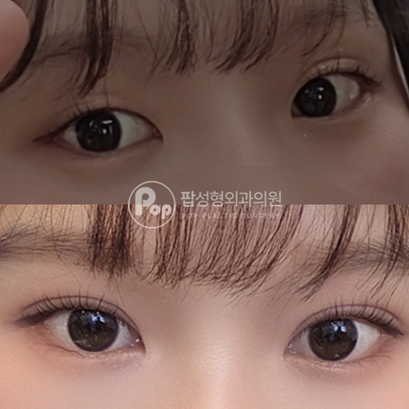 팝성형외과 비대칭 자연유착 1개월차 후기