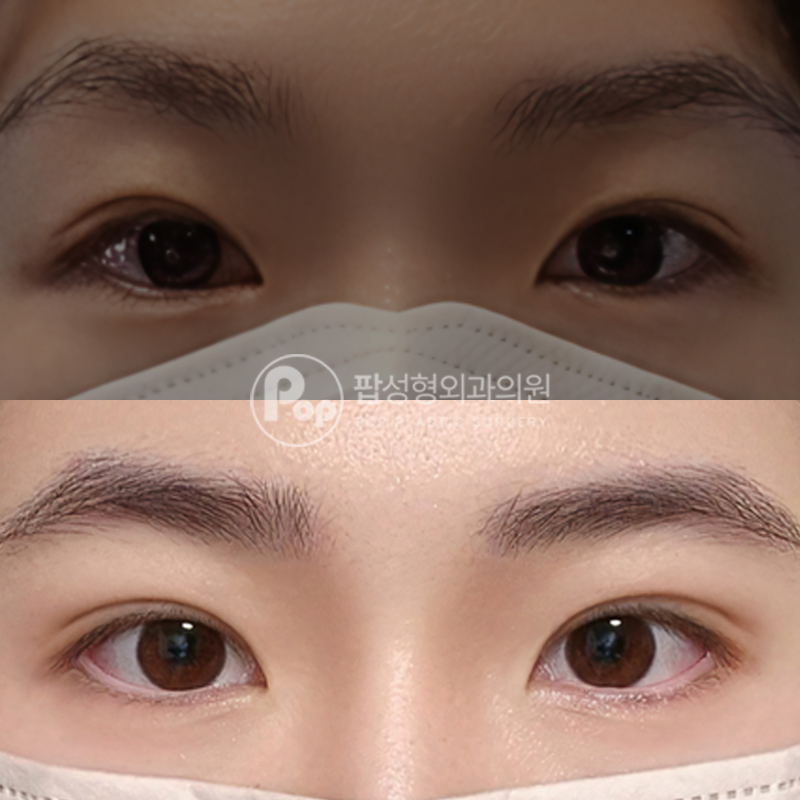 팝성형외과 비대칭라인 눈재수술 후기