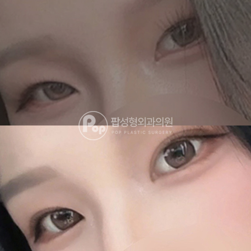 팝성형외과 인아웃라인 자연유착 후기