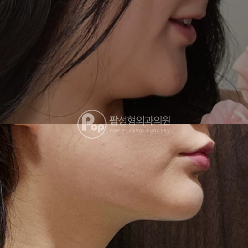 팝성형외과 이중턱 지방흡입+근육묶기 1개월차 후기