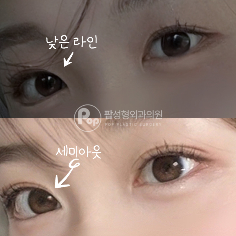 팝성형외과 세미아웃 쌍커풀 수술 트임 후기