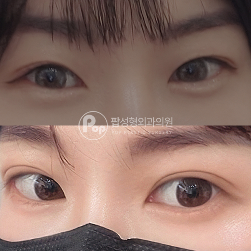 팝성형외과 풀린 라인 눈재수술 후기