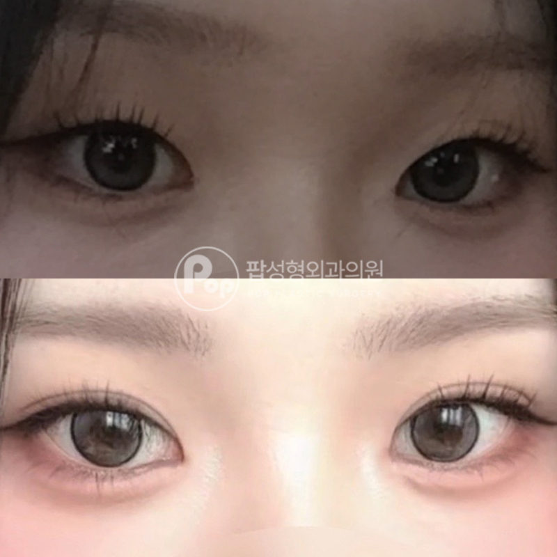 팝성형외과 겹쌍꺼풀 졸린 인상 쌍수 후기