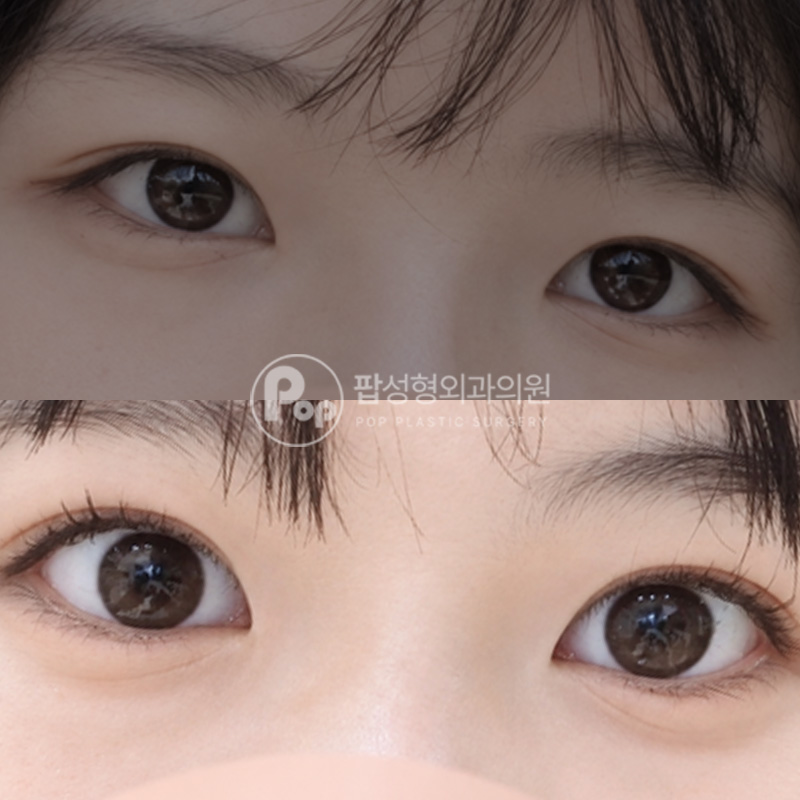 팝성형외과 자연유착 매몰 앞위트임 후기