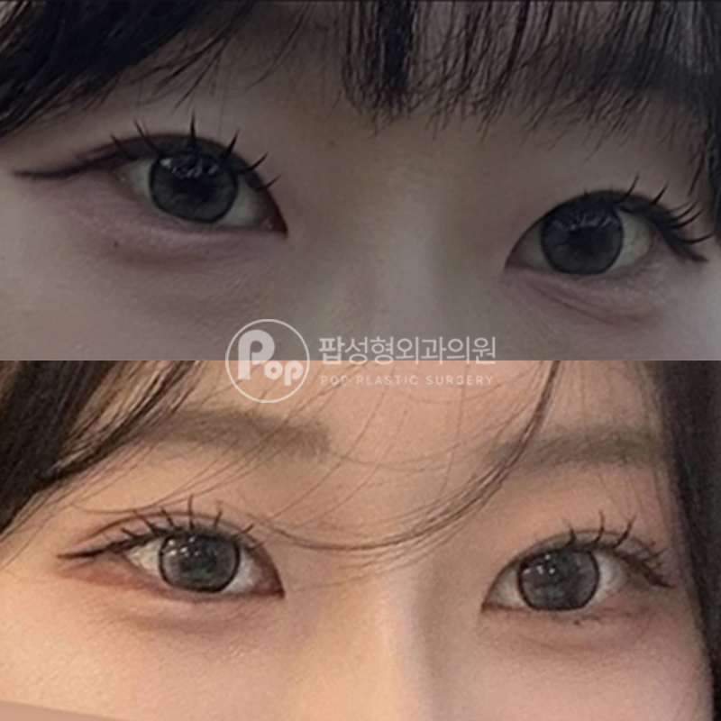 팝성형외과 눈밑지 자연유착 후기