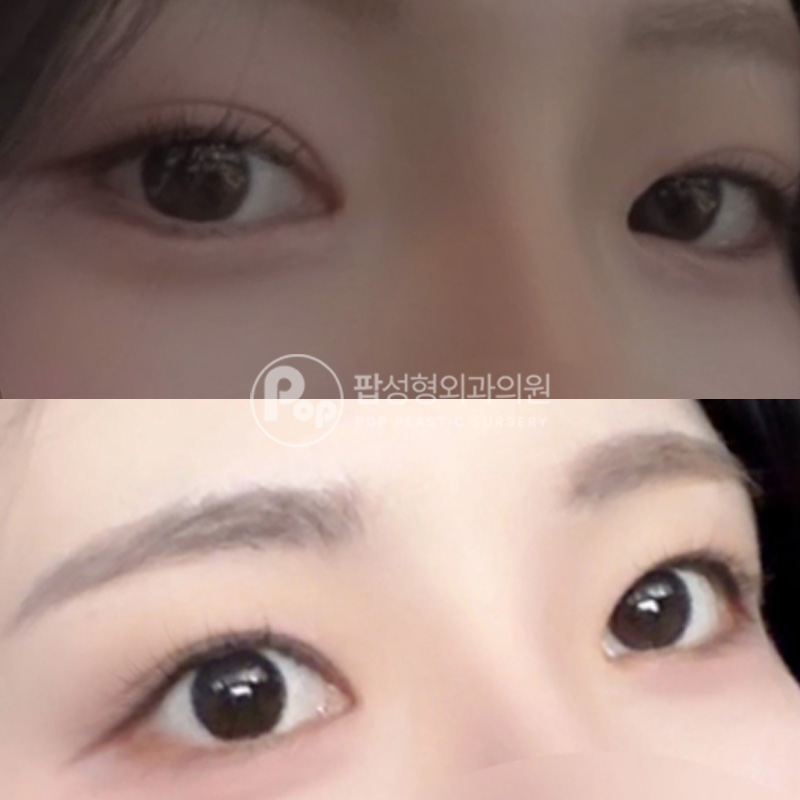 팝성형외과 답답한눈 첫트임 뒤밑트임 4개월차
