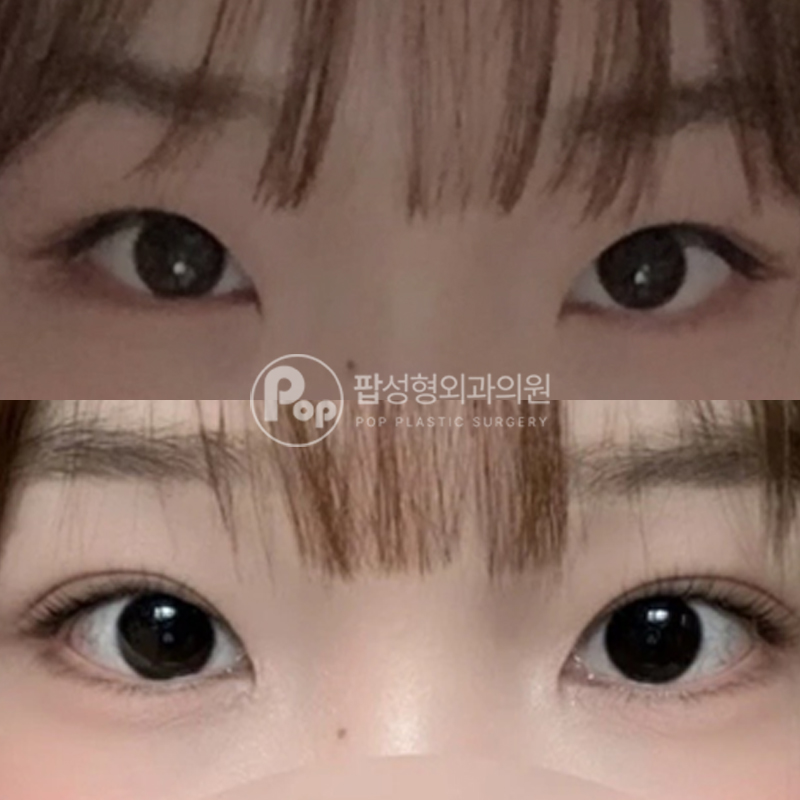 팝성형외과 몽고주름 쌍수 후기