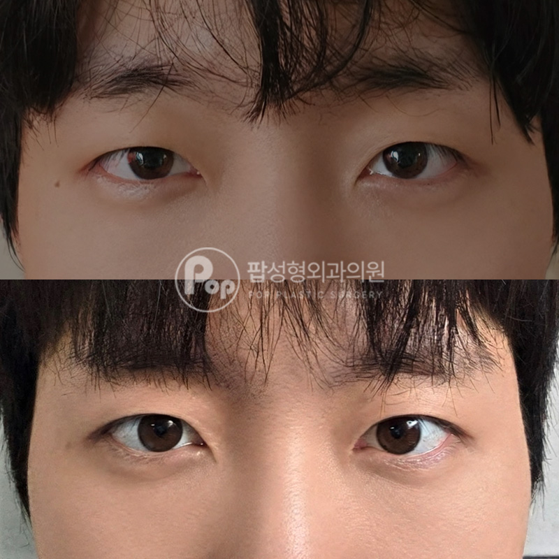 팝성형외과 돌출눈 남자눈성형 후기