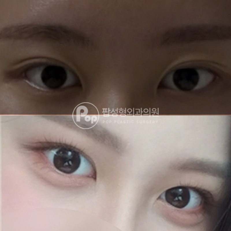 팝성형외과 비대칭 개선 자연유착 위트임 후기