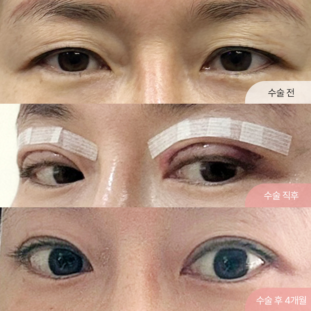 강남 팝성형외과 40대 처진 눈 절개 쌍수 찐 경과후기