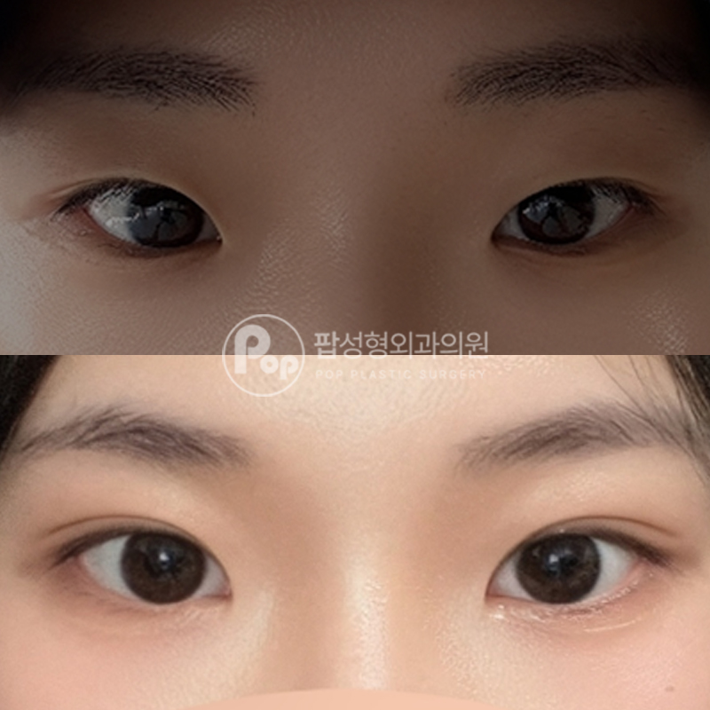 팝성형외과 인아웃라인 쌍수 후기