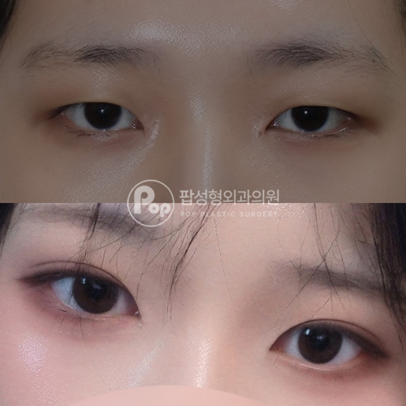 팝성형외과 사나운인상 자연유착 후기