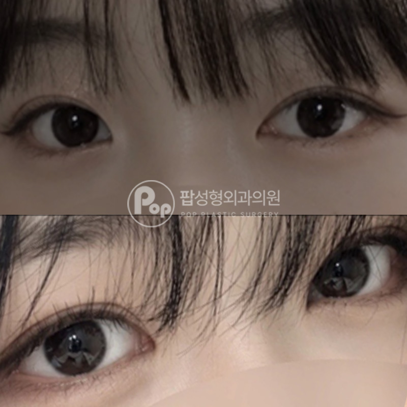 팝성형외과 라인높히기 눈재수술 눈매교정 뒤트임